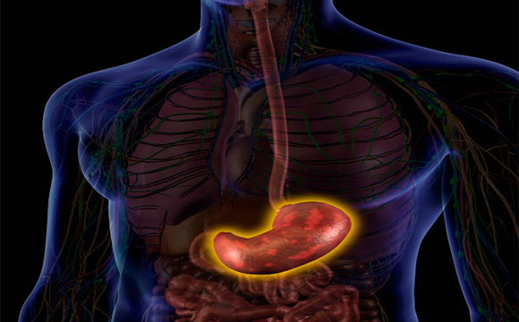 Peptic(Gastric)Ulcers